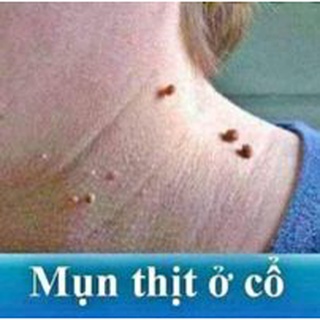 Mụn cóc , mụn thịt , mắt cá , chai chân Nunamin