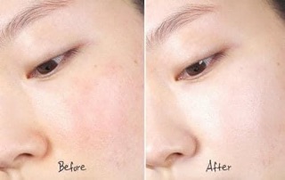 [BILL HÀN] SERUM B5 THE ORDINARY