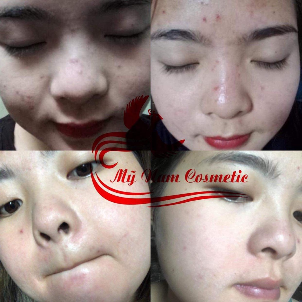 Combo dưỡng da mỹ nam -cải thiên tận gốc mụn, thâm nám, tàn nhang