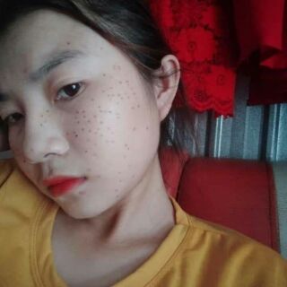 chấm tàn nhang phương anh