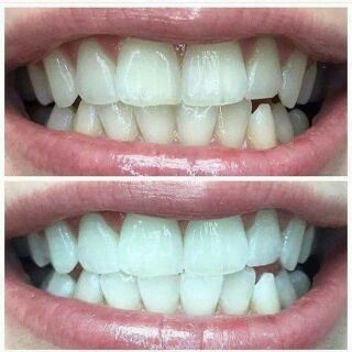 Bột Trắng Răng Than Hoạt Tính