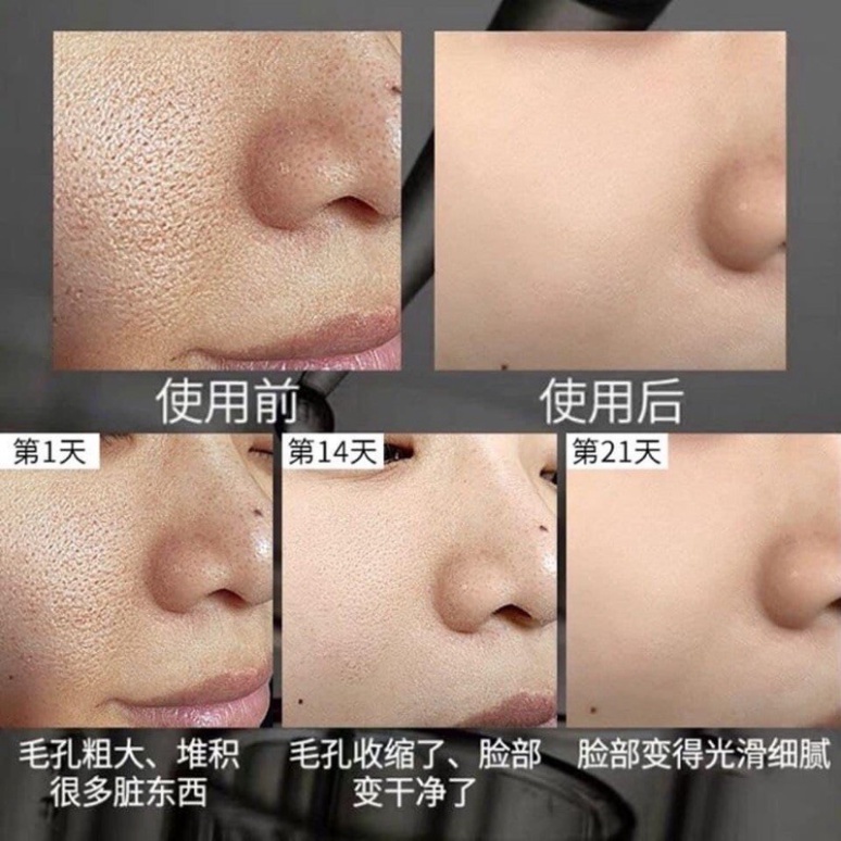 SERUM THOA NHỎ LỖ CHÂN LÔNG