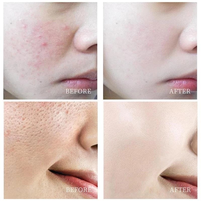 Tinh chất Melao Salicylic Acid 2% dưỡng ẩm se khít lỗ chân lông tẩy tế bào chết chăm sóc da hiệu quả 30ml