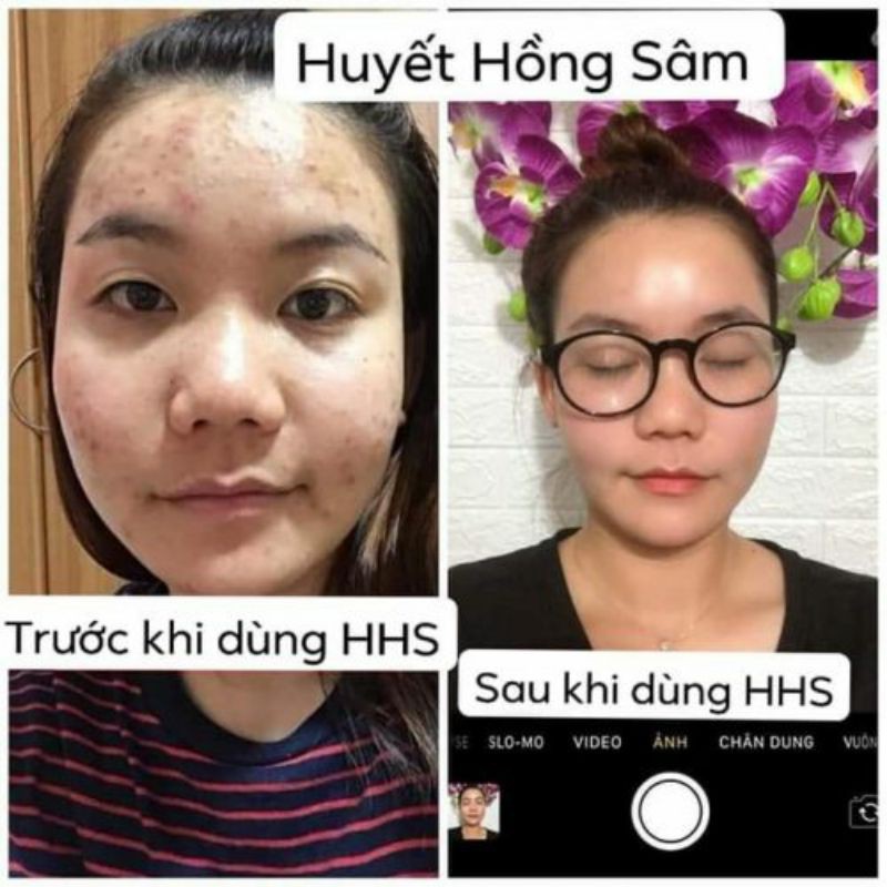 Serum làm giảm mụn, thâm, nám tàn nhang, tái tạo, phục hồi da của Đông Y Vũ Đức Huyết hồng sâm Ohana 10ml | BigBuy360 - bigbuy360.vn