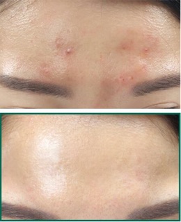 AHA – BHA – PHA 30 Days Miracle Toner