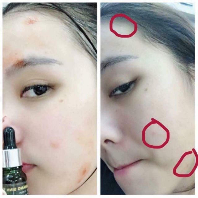 Serum chăm sóc da Mụn (Serum KST) Dr.Antinn | Hathor Beauty (Kim Thiên Hoa) | BigBuy360 - bigbuy360.vn