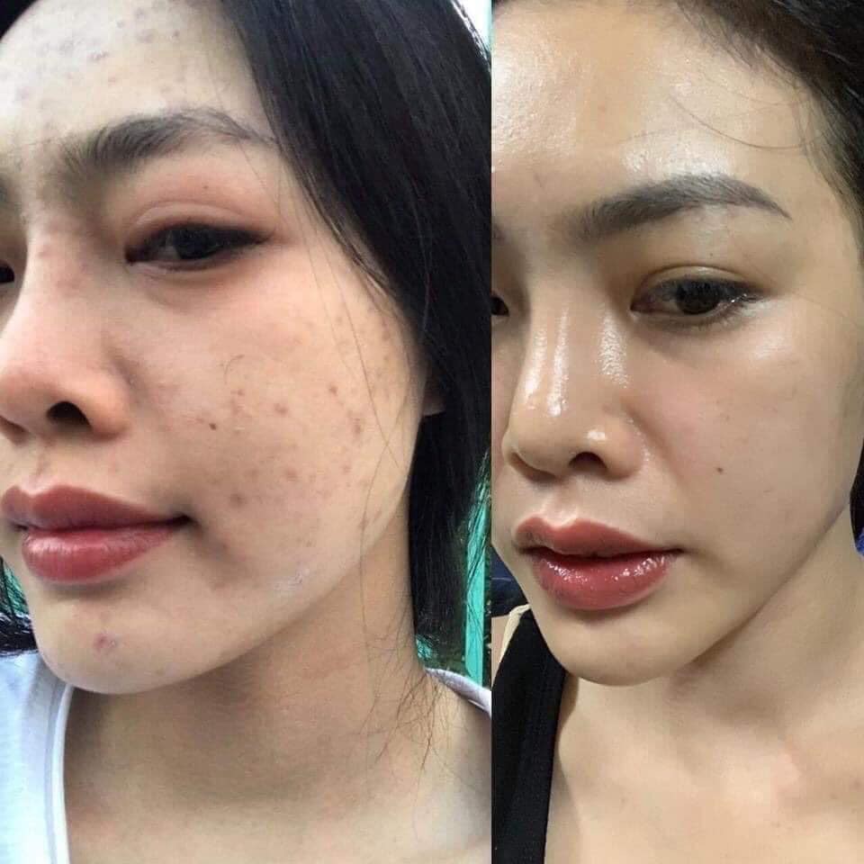 Tái Tạo Siêu Tốc Dành Cho Da Lì Sắc Mộc Thiên - Trị Mụn Thâm - Sẹo Rỗ - Nám Tàn Nhang | BigBuy360 - bigbuy360.vn