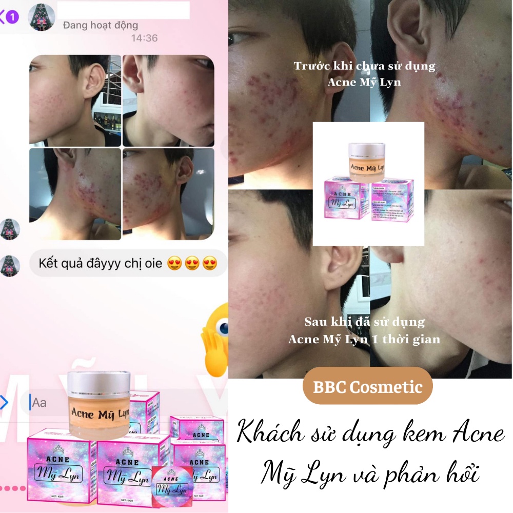 Kem giảm mụn Acne Mỹ Lyn Hũ Nhỏ 5g giúp giảm mụn, ngừa thâm hiệu quả sau 7-10 ngày sử dụng