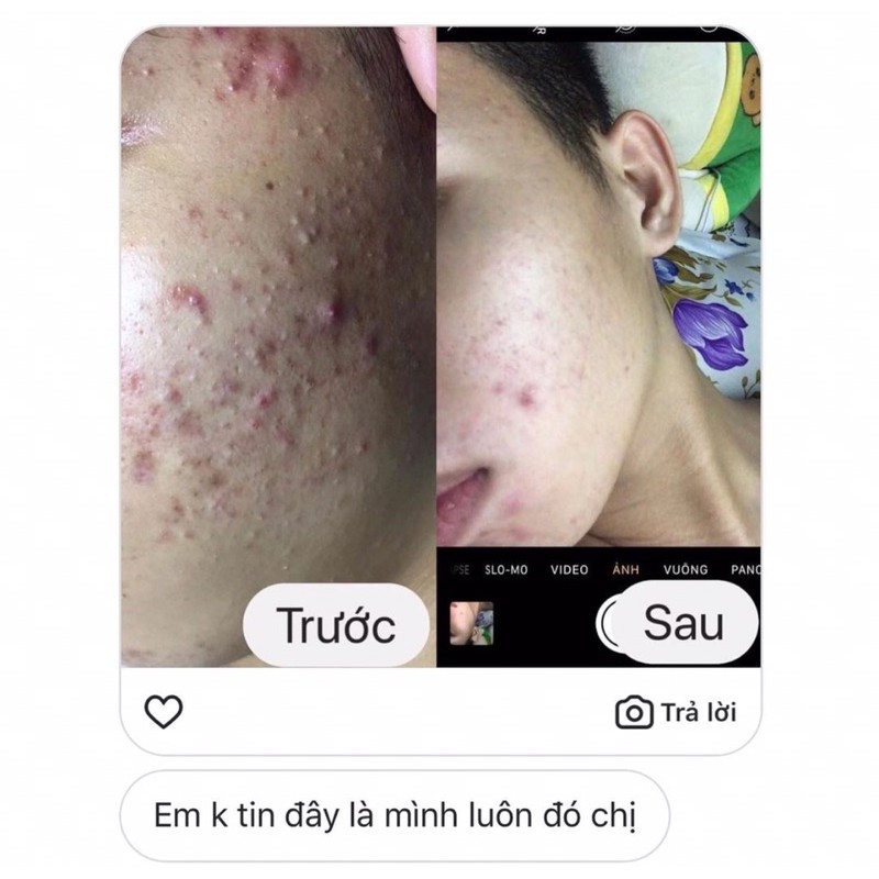 TURMERIC EXTRACT -ĐÁNH BAY MỤN ẨN VÀ CÁC LOẠI MỤN | BigBuy360 - bigbuy360.vn