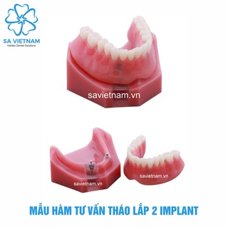 Mẫu tư vấn tháo lắp 2 implant, 4 implant - Hàm tư vấn nha khoa, Mẫu tư vấn nha khoa