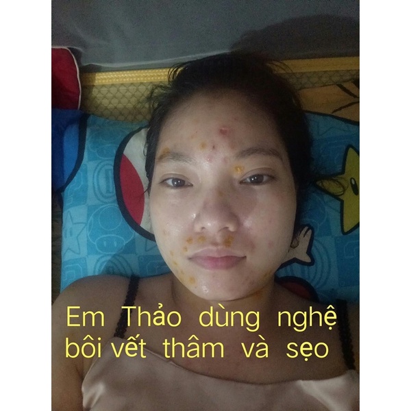 [Chính hãng] Kem nghệ đa năng Mulrose ngừa mụn đẹp da mờ sẹo