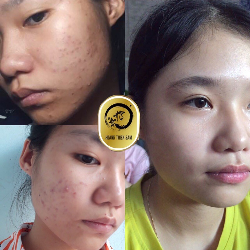 Hoàng Thiên Sâm bản truyền thống ⚡️Freeship ⚡️tiết kiệm hơn với bản truyền thống da vẫn đẹp như ý.