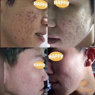 Bột rửa mặt OGANA cho da mụn
