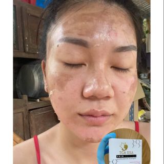 PEEL THAY DA MẶT TCA USA TRIỆT HẲ NÁM. SẸO RỔ, THÂM. TÀN NHANG, ĐỒI MỒI