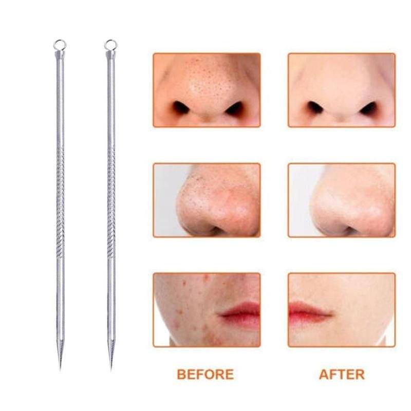 1 cây nặn mụn đầu đen bằng thép không gỉ