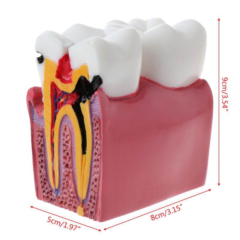 Khuôn 6 Răng Hỗ Trợ Giảng Dạy Giảm Cân