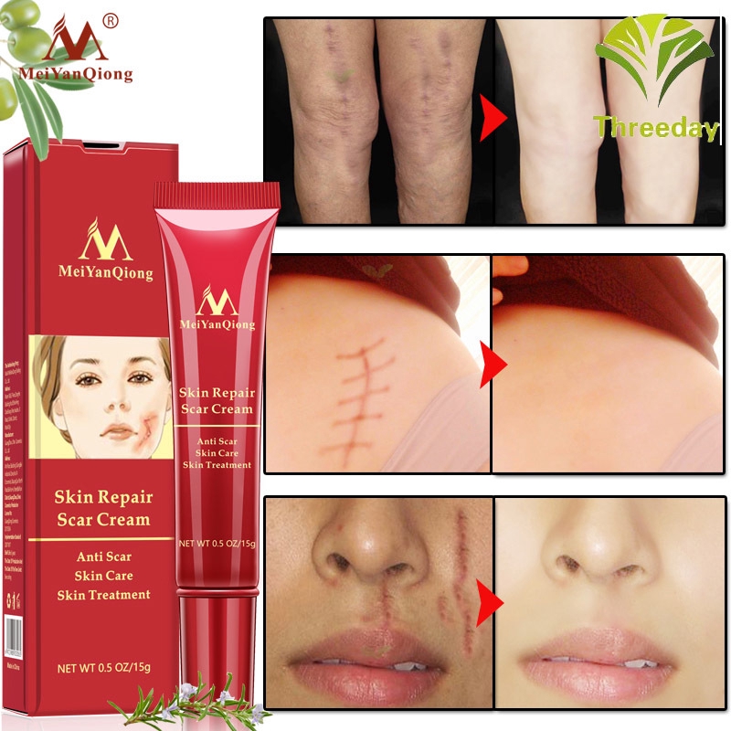 3D❤ Scar Repair Cream Skin Care Natural Acne Remove Burn Stretch Marks Scar Removal