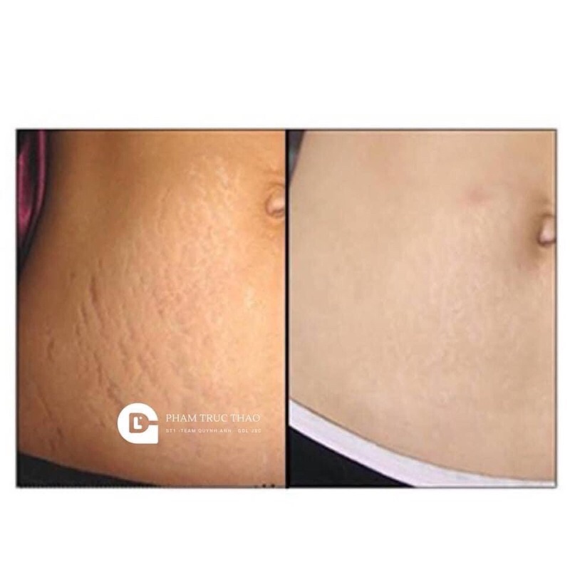 Bi.o oi.l trij rạn da mẹ bầu