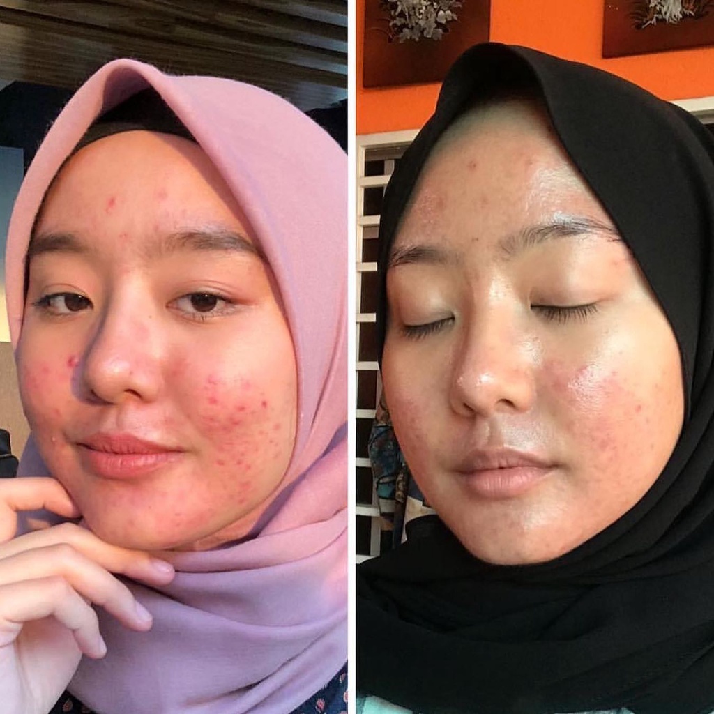 Serum rau má Skin1004 Madagascar Centella Asiatica 100 Ampoule