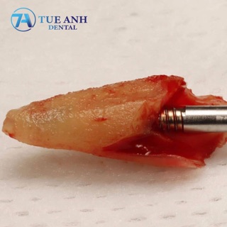 CÂY VẶN VIS NHỔ CHÂN RĂNG