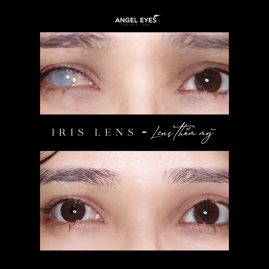  Lens thẩm mỹ che khuyết điểm Angel Eyes dành cho mắt bị đục thủy tinh thế, kéo mây, cườm