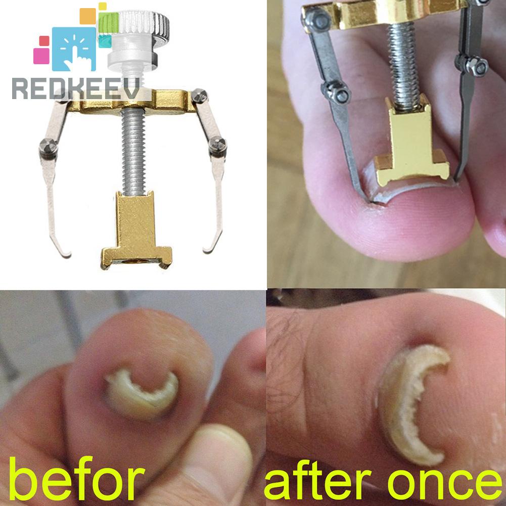 Dụng Cụ Chỉnh Sửa Móng Chân Mọc Ngược