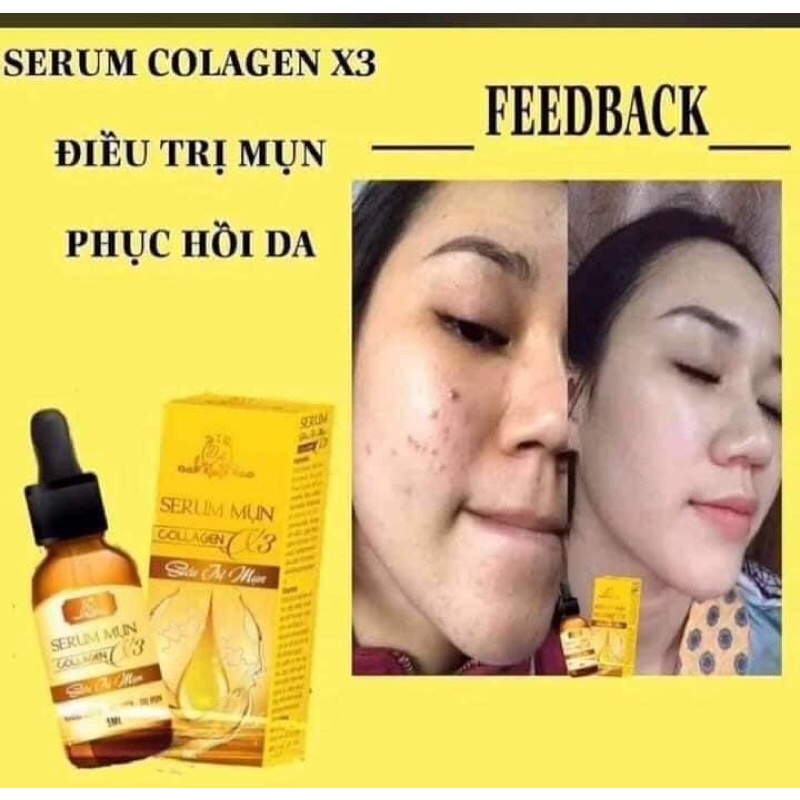 Serum mụn Collagen X3 Luxury mỹ phẩm Đông Anh Chính Hãng