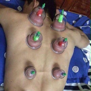 Bộ giác hơi 12 cốc