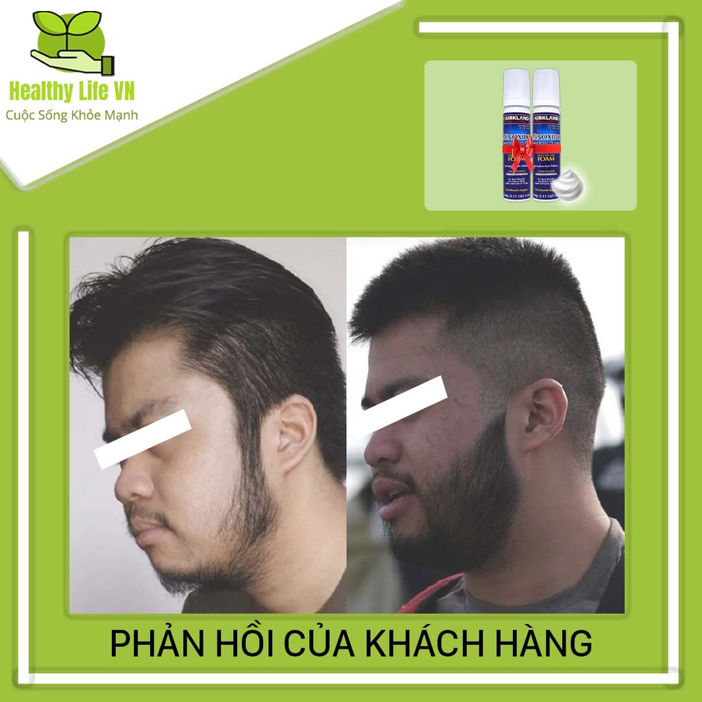 Minoxidil 5% Dạng Bọt Mọc Râu Tóc Kirkland Mỹ Combo 2 Lọ