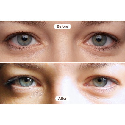 [Mẫu Mới] Kem Mắt Giảm Nhăn & Thâm RoC Retinol Correxion Eye Cream