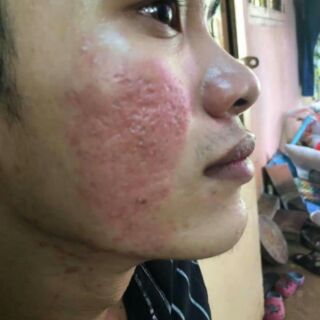 BONG NÁM +CHÂN RỖ PHƯƠNG ANH