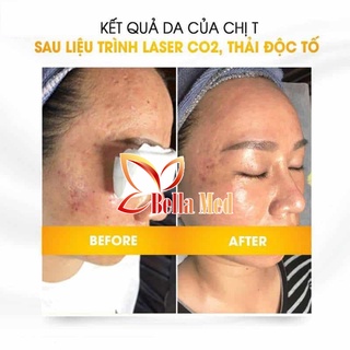 miếng mặt nạ giấy thải độc CO2 DJ Carbon Therapy ( không kèm Tuýp gel )
