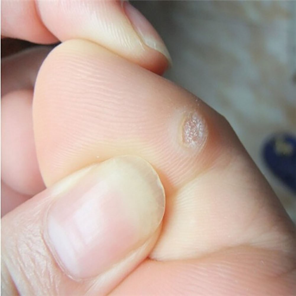 Miếng dán loại bỏ vết chai sần dành cho bàn chân