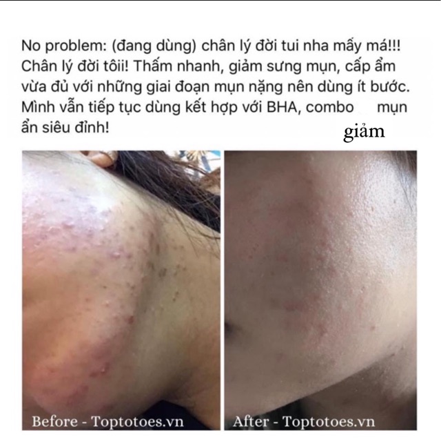 Serum Teana Super Peptides No Problem Intensive Care giảm sưng, đẩy & gom cồi mụn, giảm tiết dầu