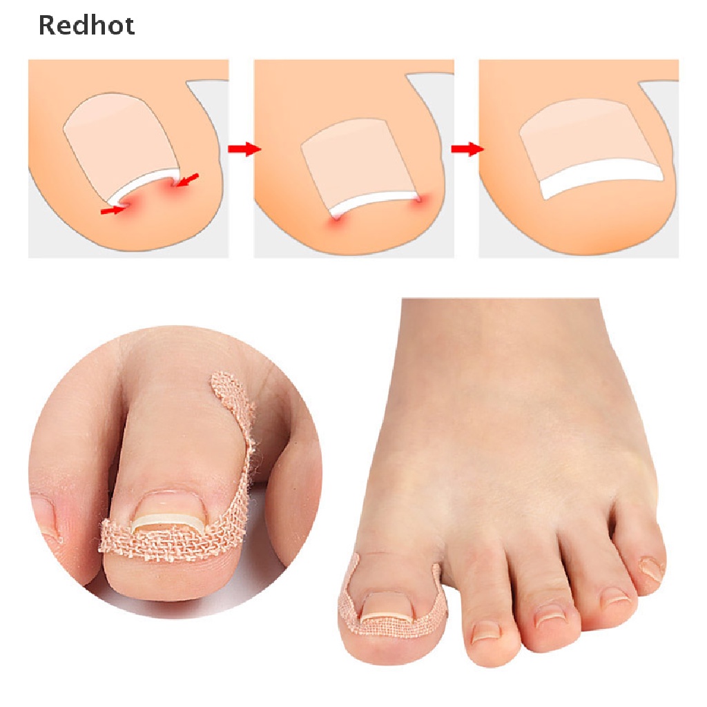 [Hàng mới về] Dụng cụ chỉnh hình móng chân hỗ trợ giảm đau