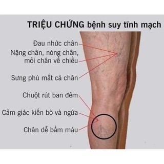 (Có bill) bộ đôi giãn tĩnh mạch Caruso