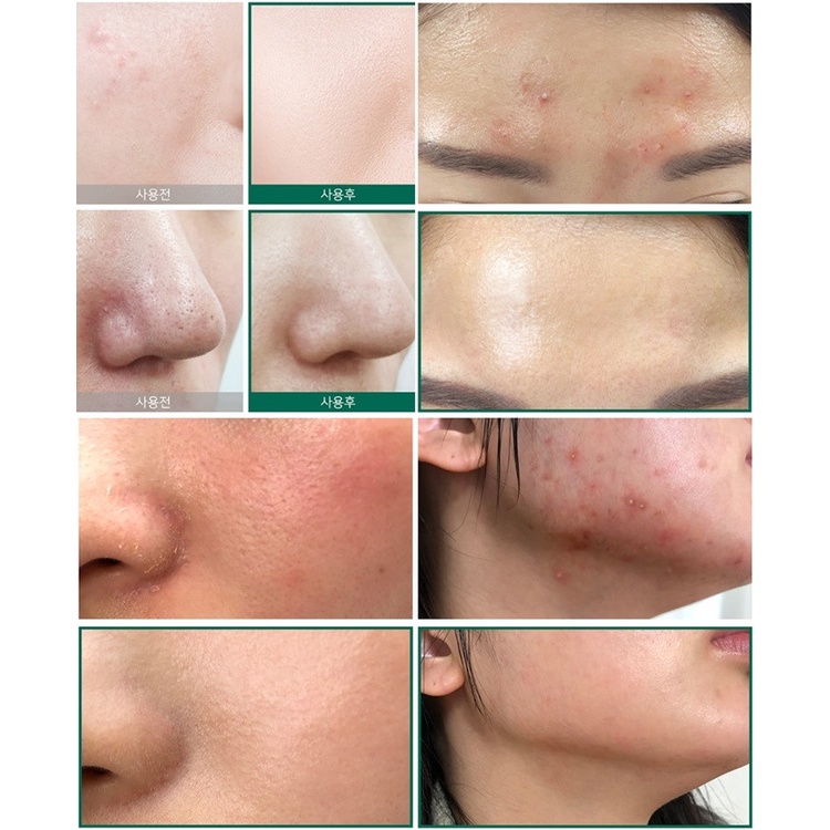 Tinh chất Some By Mi cho da mụn AHA-BHA-PHA 30 Days Miracle Serum 50ml