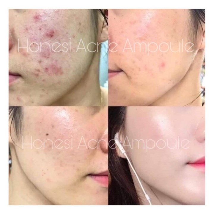 Tinh Chất Honesi Đa công dụng Ngừa Nám Mụn Siêu Trắng da 10ml – Yu646
