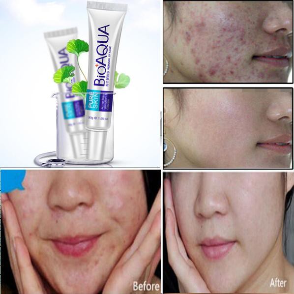 Kem dưỡng ẩm da xóa mụn Pure Skin Bioaqua