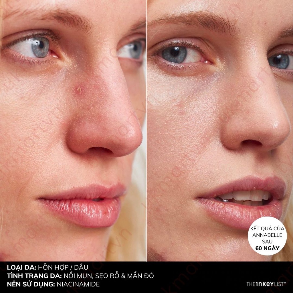 Tinh Chất The Inkey List Niacinamide Oil Control Serum 30ml Kiềm Dầu Giảm Mụn Trắng Da