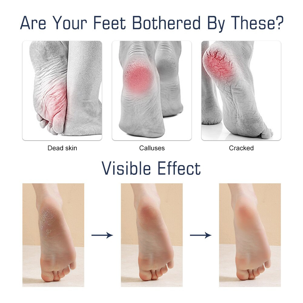 Dũa Chà Gót Chân Suolaer Chăm Sóc Bàn Chân Chuyên Nghiệp