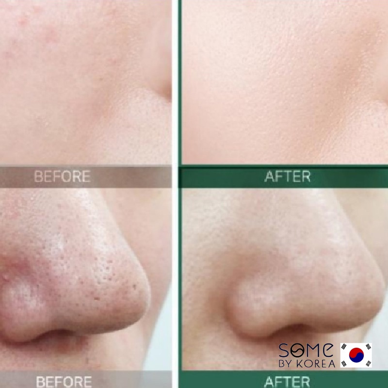 [CHÍNH HÃNG] Nước Hoa Hồng Giảm Mụn Some By Mi AHA-BHA-PHA 30 Days Miracle Toner Some By Me 150ml | BigBuy360 - bigbuy360.vn