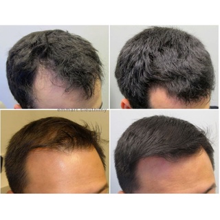 Set 3 chai xịt mọc tóc Minoxidil Bailleul 2% và 5%
