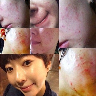 Kem Chấm Mụn Ciracle Red Spot Healing Cream