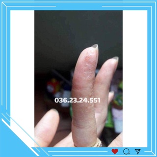 Kem bôi nấm ngứa, tổ đỉa, hắc lào, lang ben, vảy nến, á sừng, các vấn đề về da HÀNG CÓ SẴN