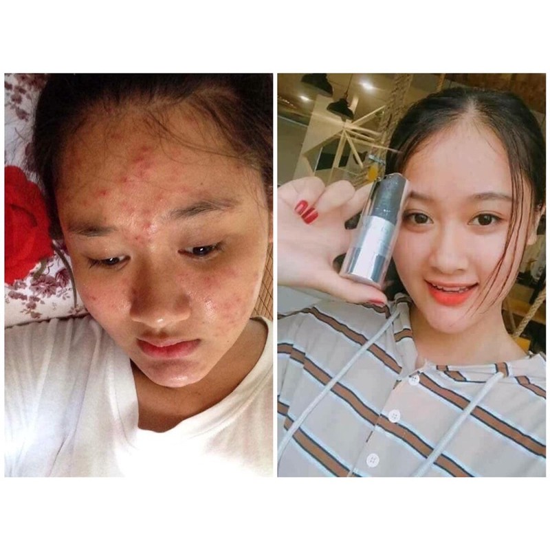 Gel mụn CENLIA 🔥[ CHÍNH HÃNG ]🔥 trả lại làn da sáng mịn sạch mụn, làm mờ thâm mụn, dứt điểm mụn hoàn toàn | BigBuy360 - bigbuy360.vn