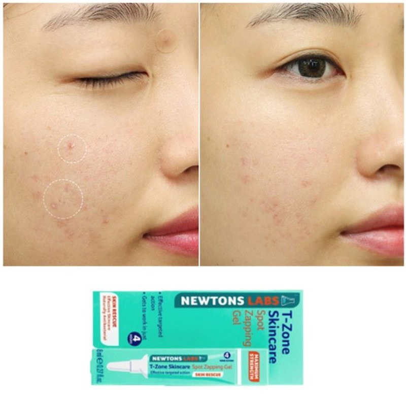 Gel ngăn mụn cấp tốc tinh chất tràm trà Newtons Labs T-Zone Spot Zapping 8ml (UK - Anh Quốc)