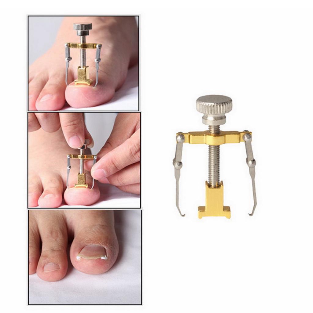 Ingrown Toenail Corrector Pedicure Tool Foot Nail Orthotic Correction Golden