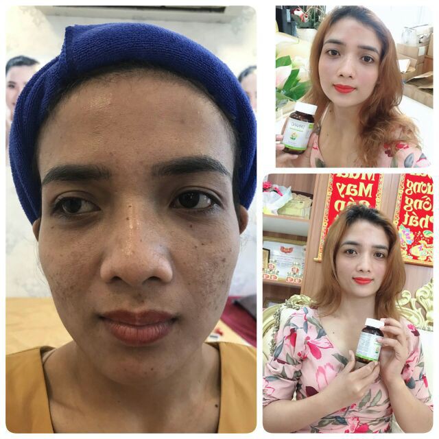 {Mua 1 tặng 3}COMBO 5 Viên Uống Trắng Da chống nắng Drnano Royal Minh Lady tặng thải độc trắng da, serum vitaminC... | BigBuy360 - bigbuy360.vn