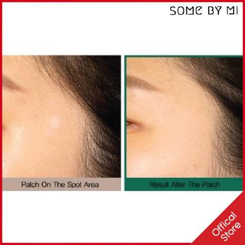 Miếng dán mụn Some By Mi Acnes Clear Patch gói 18 miếng | BigBuy360 - bigbuy360.vn